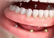 implant dentaire marseille