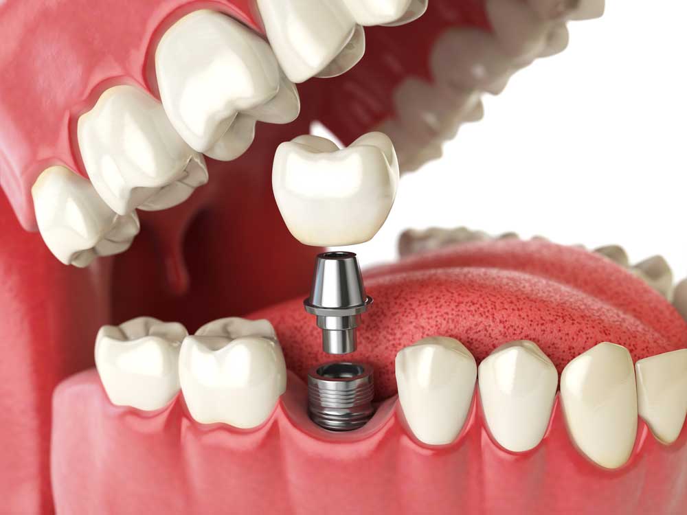 implant dentaire marseille