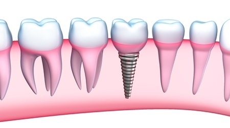 protheses dentaires