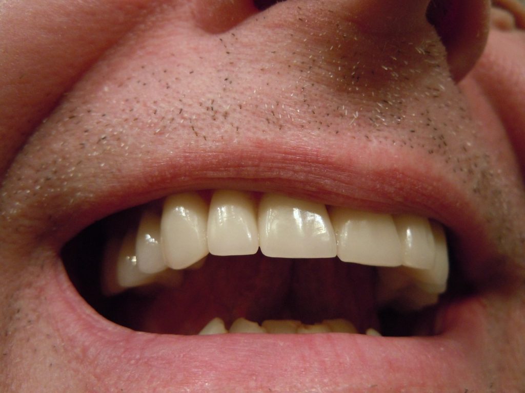 Les implants dentaires du GEPI
