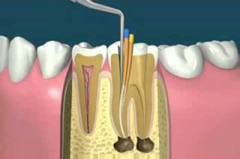 traitements endodontiques